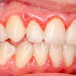 Stop Tooth Sensitivity Instantly: How Hydroxyapatite Seals Exposed Nerves
